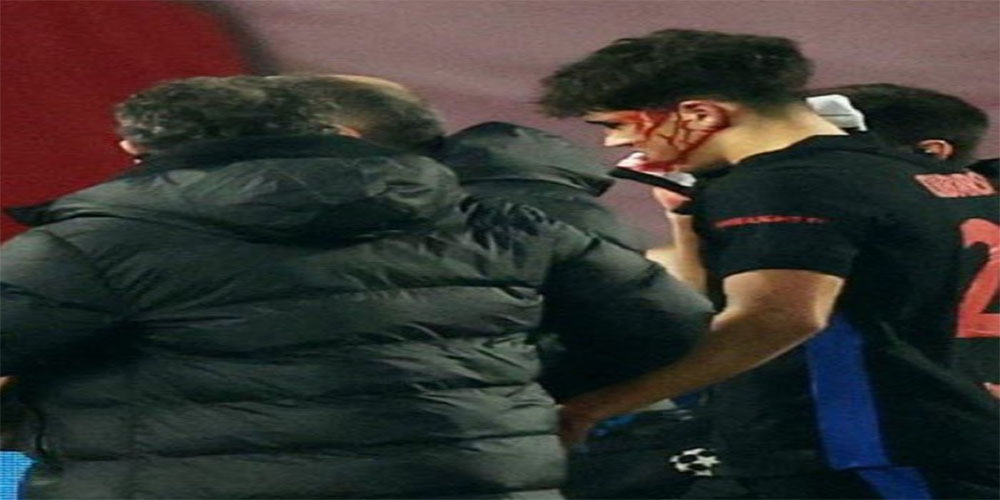 چهره جدید کوبارسی پس از مصدومیت خونین (عکس) - حاشیه های فوتبالی چهره جدید کوبارسی پس از مصدومیت خونین (عکس)