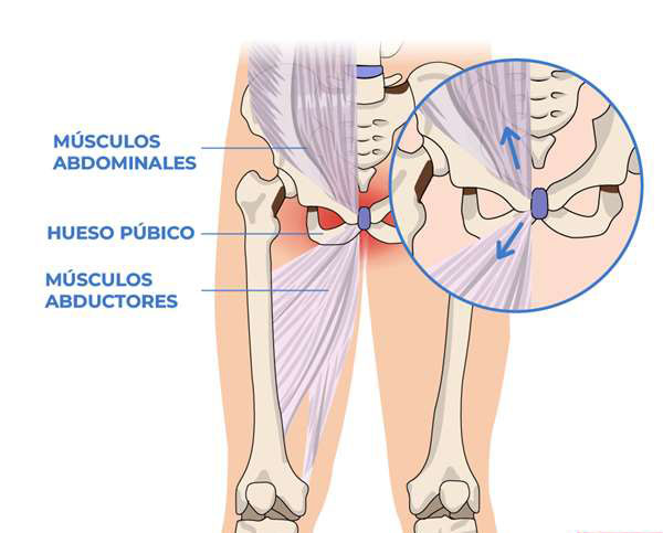 آیا استراحت مطلق میتواند پوبالژیا را درمان کند آیا استراحت مطلق میتواند پوبالژیا را درمان کند