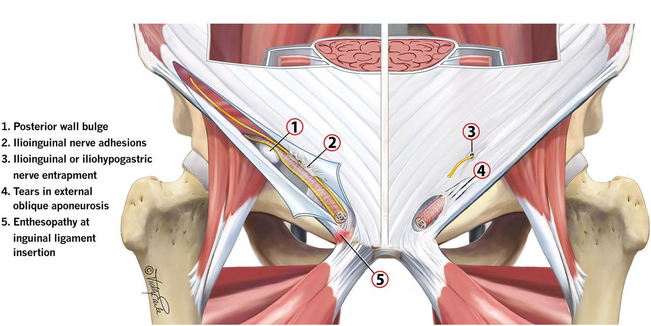 پوبالژیا بیماری کشاله ران پوبالژیا بیماری کشاله ران